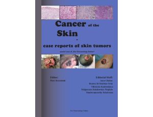 Cancer of the Skin - case reports of skin tumors